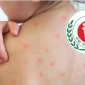 হামের উপসর্গে আরও পাঁচ শিশুর মৃত্যু